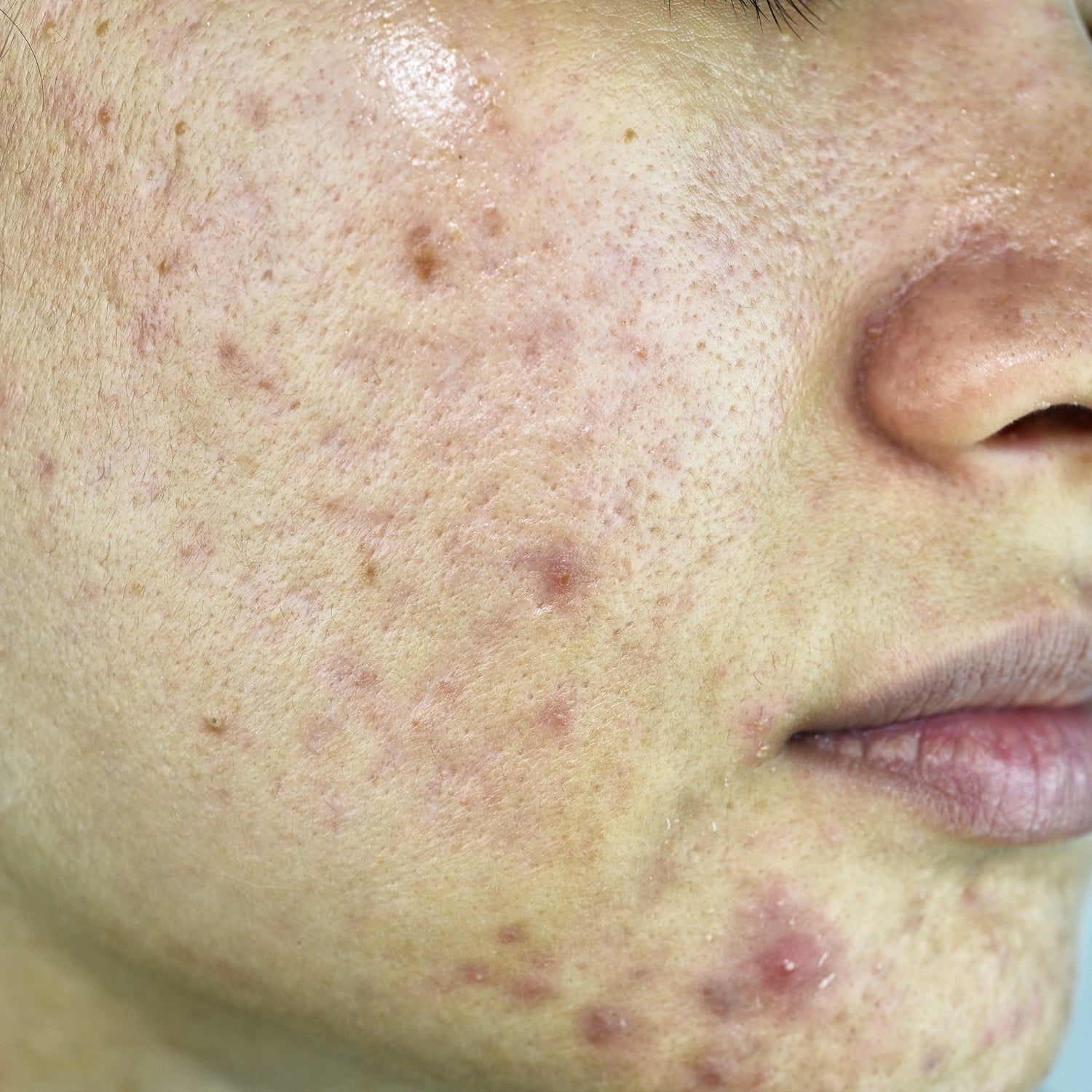Breakouts & Acne