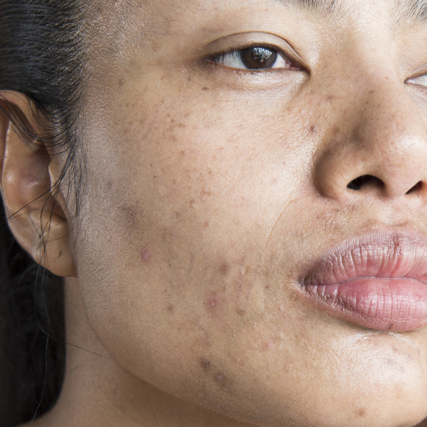Dark Spots & Hyperpigmentation