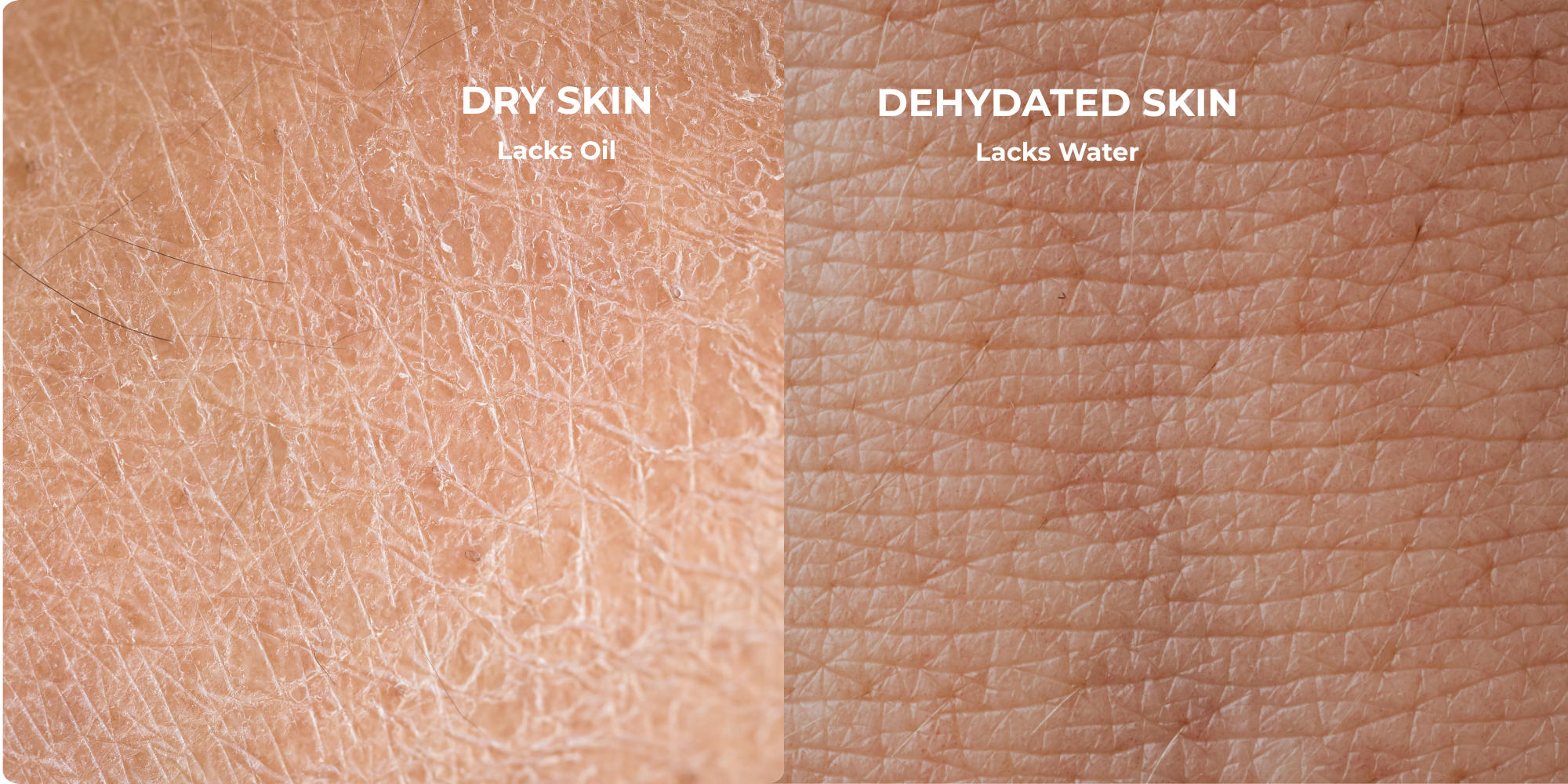 How to Prep Your Skin for Winter (And Know If It’s Dry or Dehydrated)