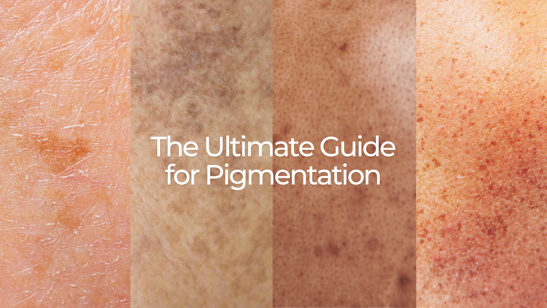Say Goodbye to Skin Pigmentation - The Ultimate Guide from Silki